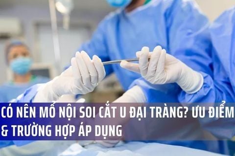 Có Nên Mổ Nội Soi Cắt U Đại Tràng? Ưu Điểm & Trường Hợp Áp Dụng