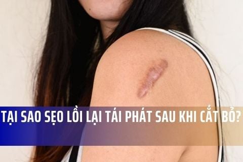 Tại Sao Sẹo Lồi Lại Tái Phát Sau Khi Cắt Bỏ?
