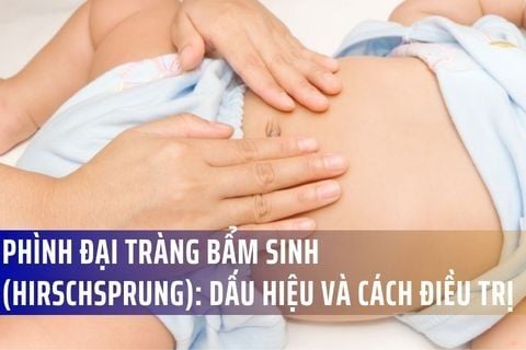 Phình Đại Tràng Bẩm Sinh (Hirschsprung): Dấu Hiệu Và Cách Điều Trị