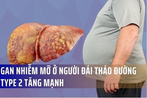 Gan nhiễm mỡ ở người đái tháo đường type 2 tăng mạnh