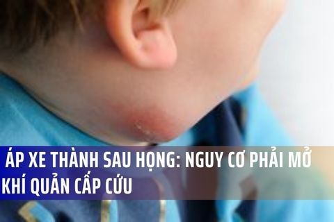 Áp Xe Thành Sau Họng: Cơn Ác Mộng Nghẹt Thở Và Nguy Cơ Phải Mở Khí Quản Cấp Cứu