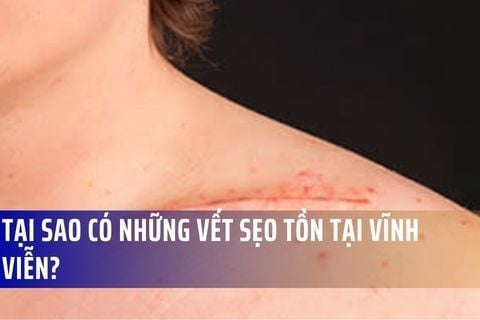 Tại sao có những vết sẹo tồn tại vĩnh viễn?