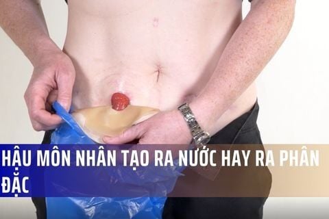Hậu môn nhân tạo ra nước hay ra phân đặc