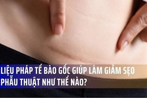 Liệu pháp Tế bào Gốc Giúp Làm Giảm Sẹo Phẫu Thuật Như Thế Nào?