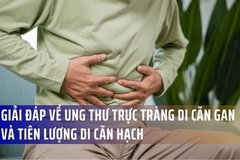 Giải đáp câu hỏi chuyên sâu về ung thư trực tràng di căn gan và tiên lượng di căn hạch