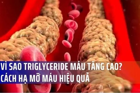 Vì Sao Triglyceride Máu Tăng Cao? Cách Hạ Mỡ Máu Hiệu Quả