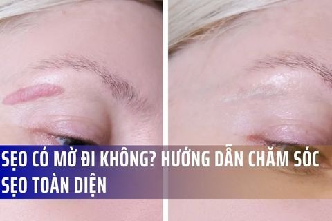Sẹo Có Mờ Đi Không? Hướng Dẫn Chăm Sóc Sẹo Toàn Diện