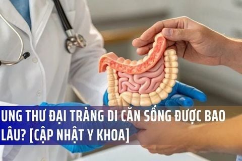 Ung Thư Đại Tràng Di Căn Sống Được Bao Lâu? [Cập Nhật Y Khoa]