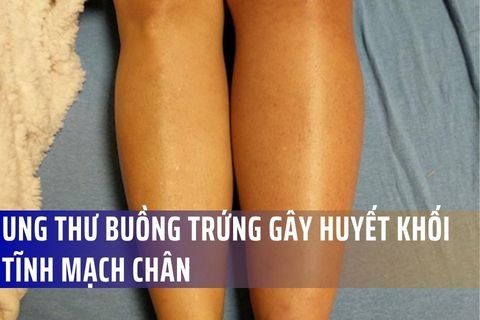 Ung thư buồng trứng gây huyết khối tĩnh mạch chân