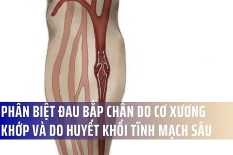 Phân biệt đau bắp chân do cơ xương khớp và do huyết khối tĩnh mạch sâu (DVT)