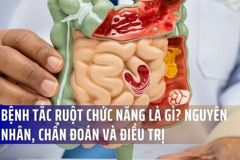 Bệnh Tắc Ruột Chức Năng (Ileus) Là Gì? Nguyên Nhân, Triệu Chứng, Chẩn Đoán Và Điều Trị