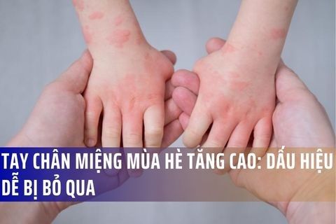 Tay Chân Miệng Mùa Hè Tăng Cao: Dấu Hiệu Dễ Bị Bỏ Qua