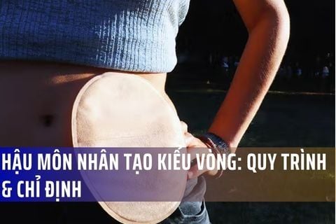 Hậu Môn Nhân Tạo Kiểu Vòng: Quy Trình & Chỉ Định