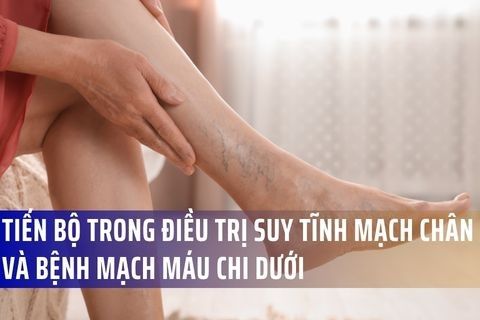 Tiến Bộ Trong Điều Trị Suy Tĩnh Mạch Chân Và Bệnh Mạch Máu Chi Dưới