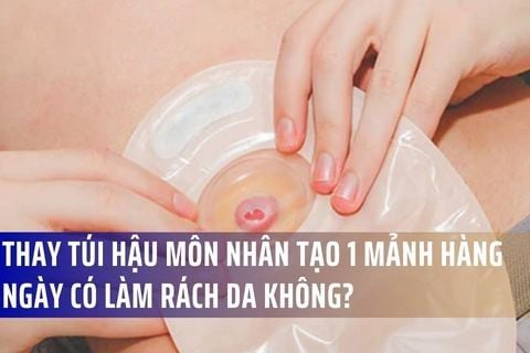 Thay túi hậu môn nhân tạo 1 mảnh hàng ngày có làm rách da không?