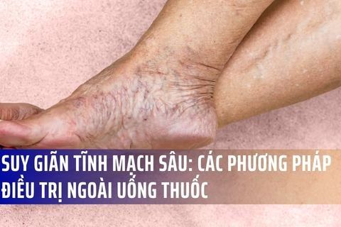 Suy Giãn Tĩnh Mạch Sâu: Các Phương Pháp Điều Trị Ngoài Uống Thuốc