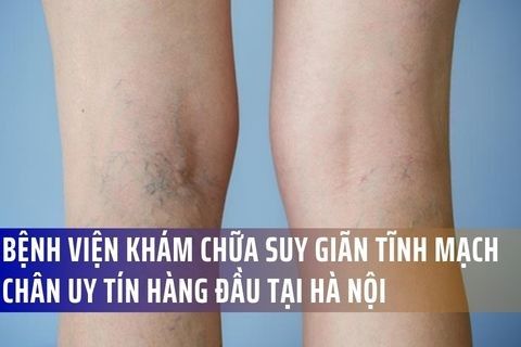 Top 5 Bệnh Viện Khám Chữa Suy Giãn Tĩnh Mạch Chân Uy Tín Hàng Đầu Tại Hà Nội