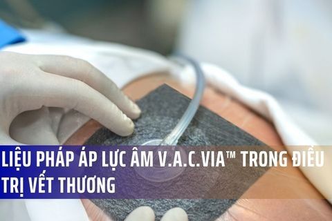 Liệu pháp áp lực âm V.A.C.Via™ trong điều trị vết thương