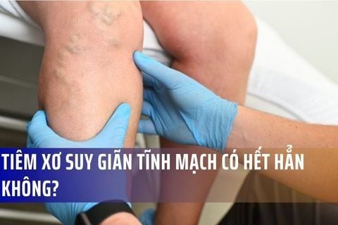 Giải đáp: Tiêm xơ suy giãn tĩnh mạch có hết hẳn không? Chi phí có được BHYT chi trả?