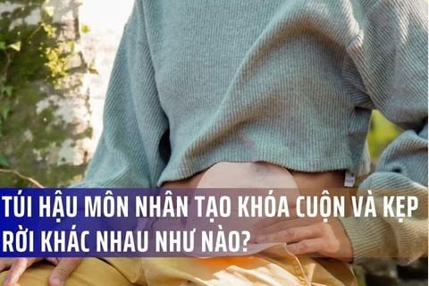 Túi hậu môn nhân tạo khóa cuộn và kẹp rời khác nhau như nào?