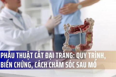 Phẫu Thuật Cắt Đại Tràng: Quy Trình, Biến Chứng Và Cách Chăm Sóc Sau Mổ
