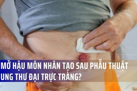 Mở hậu môn nhân tạo sau phẫu thuật ung thư đại trực tràng?