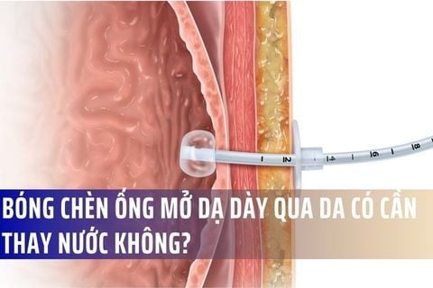 Bóng chèn ống mở dạ dày qua da có cần thay nước không?