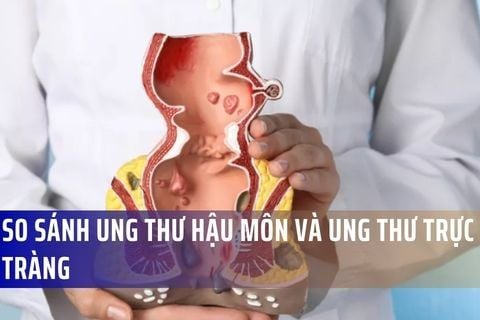 So sánh Ung thư Hậu môn và Ung thư Trực tràng: Triệu chứng, Nguyên nhân, Điều trị và Tiên lượng