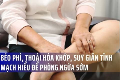 Mối liên hệ giữa béo phì, thoái hóa khớp và suy giãn tĩnh mạch: Hiểu đúng để phòng ngừa sớm