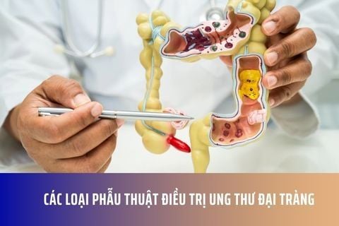 Các loại phẫu thuật điều trị ung thư đại tràng