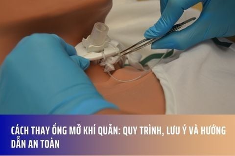 Cách Thay Ống Mở Khí Quản: Quy Trình, Lưu Ý và Hướng Dẫn An Toàn