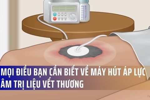 Mọi điều bạn cần biết về Máy hút áp lực âm trị liệu vết thương (Wound Vac)