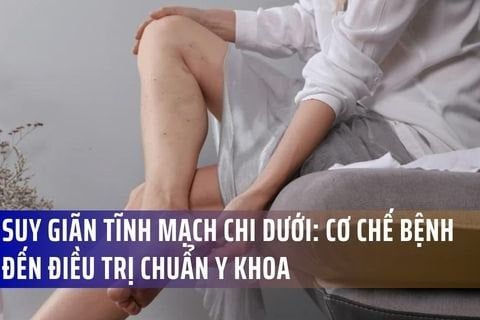 Suy Giãn Tĩnh Mạch Chi Dưới: Từ Cơ Chế Sinh Lý Bệnh Đến Nguyên Lý Điều Trị Chuẩn Y Khoa