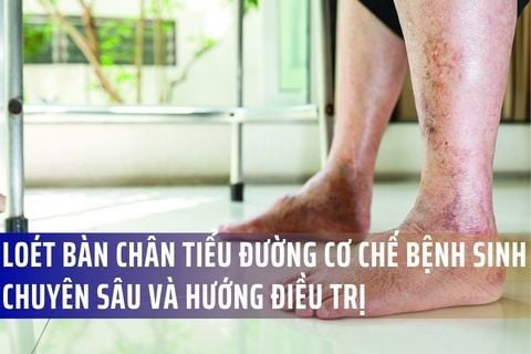 Loét bàn chân tiểu đường: Cơ chế bệnh sinh chuyên sâu và hướng điều trị mới nhất 2026