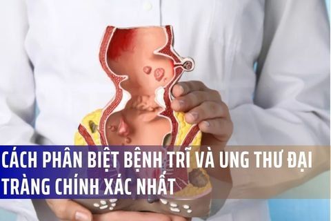 Cách Phân Biệt Bệnh Trĩ Và Ung Thư Đại Tràng Chính Xác Nhất