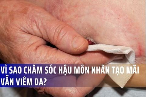 Vì sao chăm sóc hậu môn nhân tạo mãi vẫn viêm da? ThS.BS CKII BV Việt Đức lý giải