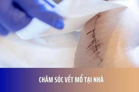 Chăm Sóc Vết Mổ Tại Nhà