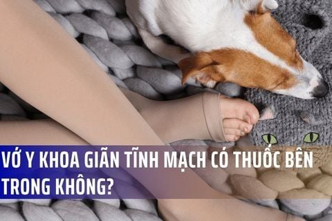 Vớ y khoa giãn tĩnh mạch có thuốc bên trong không?