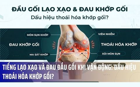 Tiếng Lạo Xạo Và Đau Đầu Gối Khi Vận Động: Dấu Hiệu Thoái Hóa Khớp Gối?