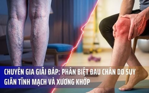 Chuyên Gia Giải Đáp: Phân Biệt Đau Chân Do Suy Giãn Tĩnh Mạch Và Xương Khớp