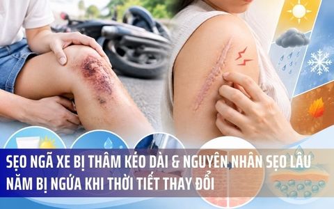 Sẹo Ngã Xe Bị Thâm Kéo Dài & Nguyên Nhân Sẹo Lâu Năm Bị Ngứa Khi Thời Tiết Thay Đổi