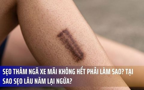 Sẹo Thâm Ngã Xe Mãi Không Hết Phải Làm Sao? Tại Sao Sẹo Lâu Năm Lại Ngứa?