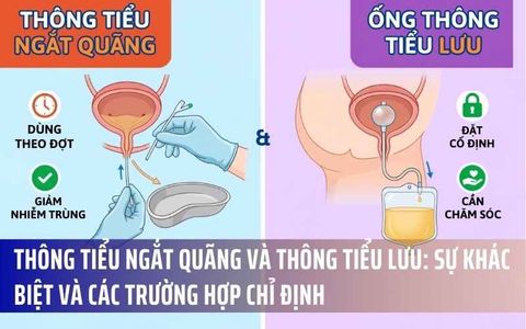 Thông Tiểu Ngắt Quãng Và Thông Tiểu Lưu: Sự Khác Biệt Và Các Trường Hợp Chỉ Định
