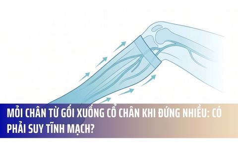Mỏi Chân Từ Gối Xuống Cổ Chân Khi Đứng Nhiều: Có Phải Suy Tĩnh Mạch?