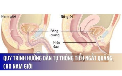 Quy Trình Hướng Dẫn Tự Thông Tiểu Ngắt Quãng Cho Nam Giới