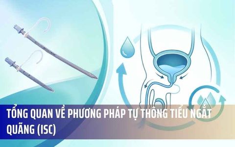 Tổng Quan Về Phương Pháp Tự Thông Tiểu Ngắt Quãng (ISC)