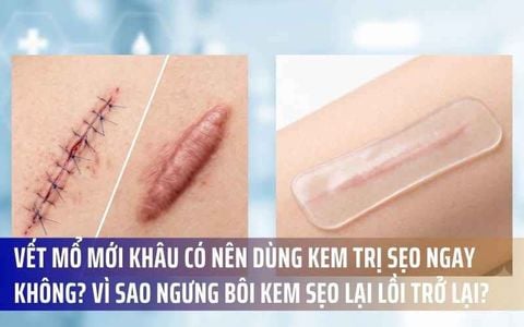Vết Mổ Mới Khâu Có Nên Dùng Kem Trị Sẹo Ngay Không? Vì Sao Ngưng Bôi Kem Sẹo Lại Lồi Trở Lại?