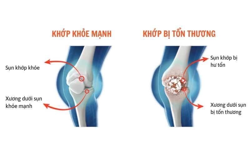 thoai-hoa-khop-goi