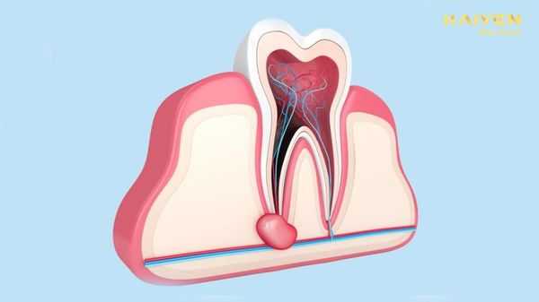 Áp Xe Răng Có Tự Khỏi Không