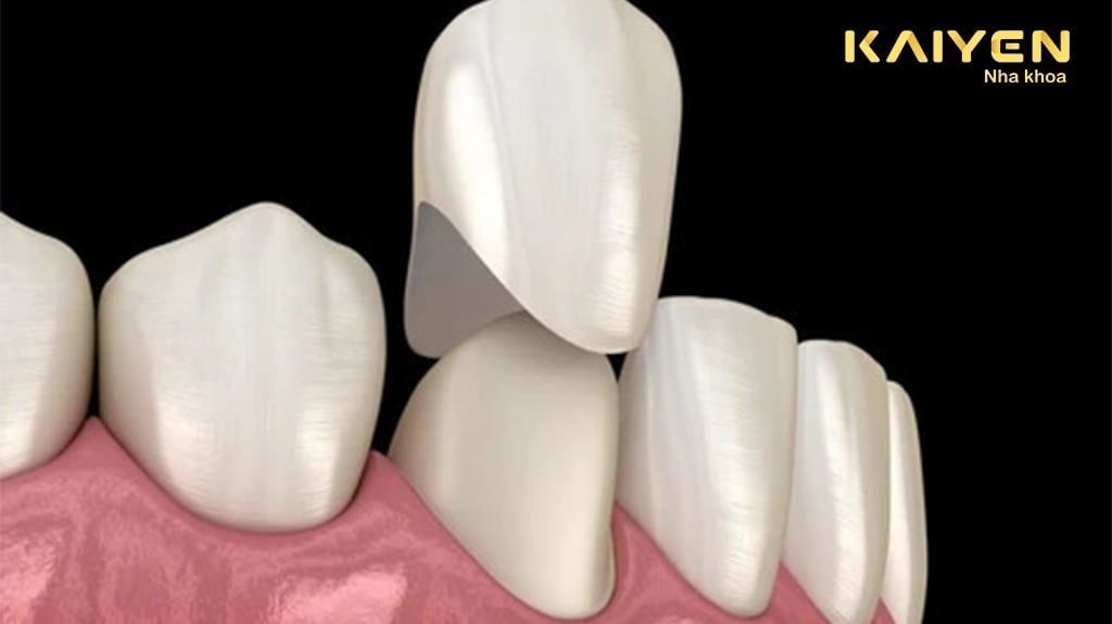 Bọc răng sứ bị tụt lợi: Nguyên nhân và cách khắc phục